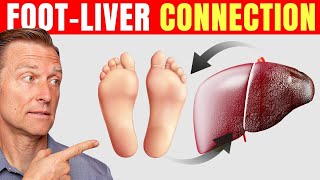 How to Use Your Feet to Diagnose Liver Problems-Dr. Berg Explains