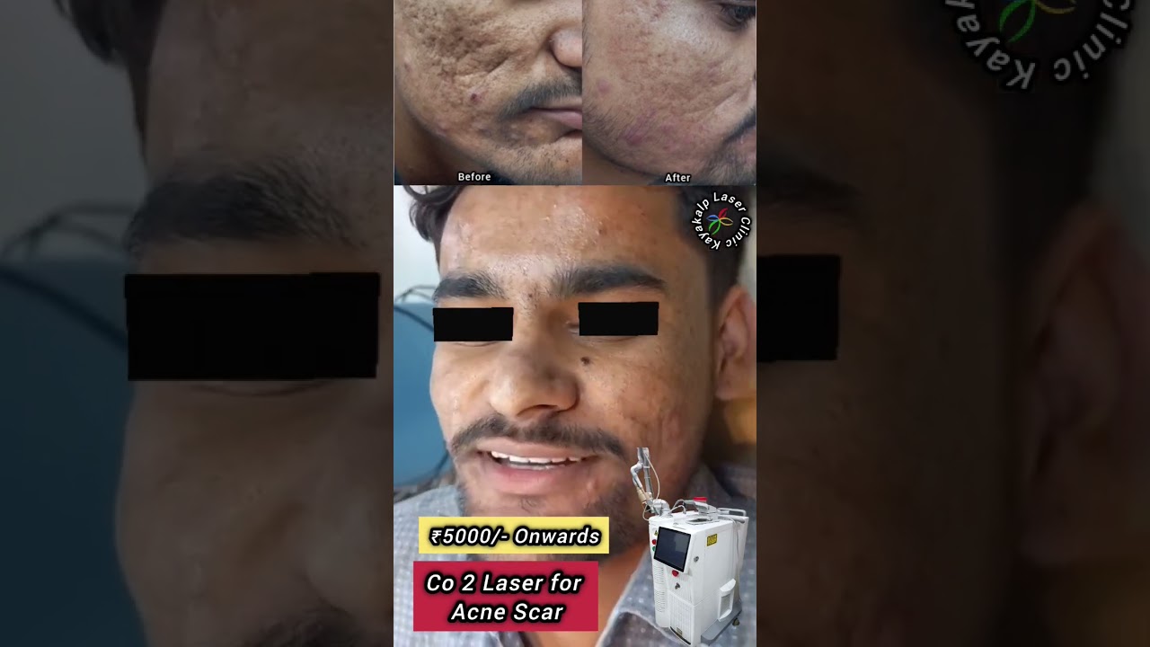 Co2 Laser Treatment | Acne Scar Removal Treatment