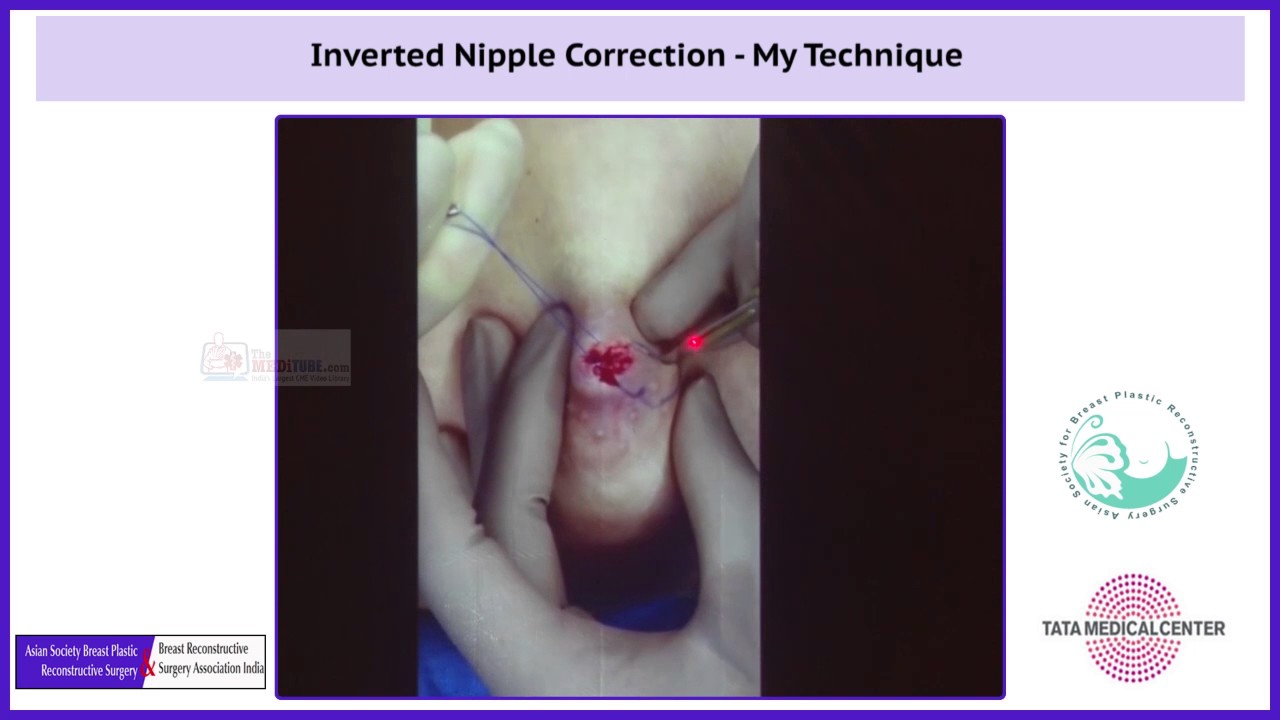 Correction Of Inverted Nipples 120