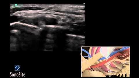 How To: Ultrasound Guided Supraclavicular Nerve Block 3D Video