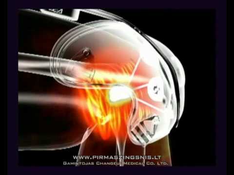 Video: Kaulų Forma Tarpininkauja Tarp Sekso Ir Kelio Sąnario Osteoartrito