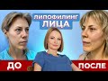 Липолифтинг лица ДО и ПОСЛЕ | Коррекция средней части лица