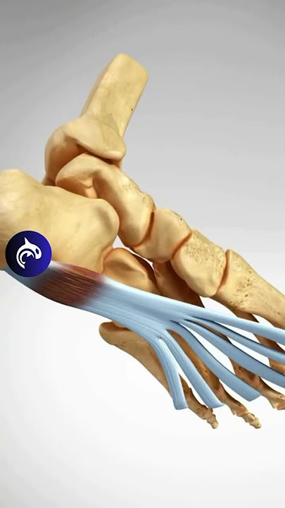 Plantar Fasciitis of the Foot