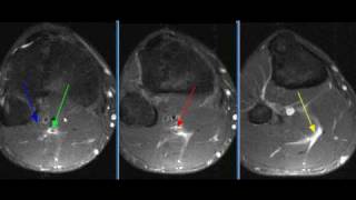 MRI Ankle Case 39