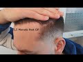 56 monate post op update  cosmedica hair transplantation clinic  dr levent acar