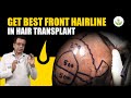 How to get best front hairline in hair transplantation  care well medical centre