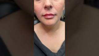 Natural lip filler before and after #lipfiller #lipfillerinjections #nurseinjector