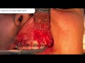 IMPACTED MAXILLARY CANINE SURGERY | REAL CASE 🦷