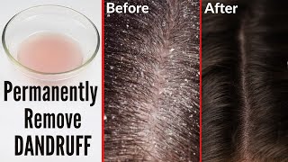 How to cure dandruff permanently naturally at home screenshot 3