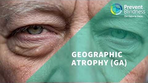Geographic Atrophy (GA)