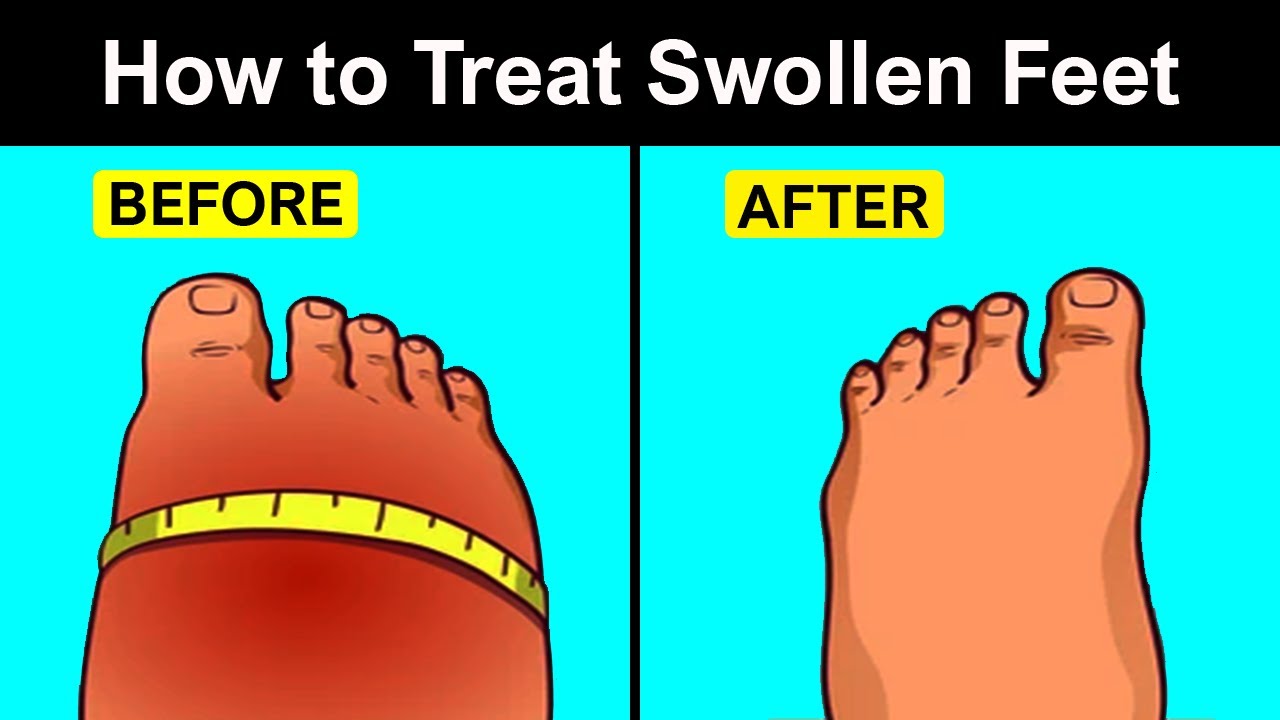 Natural Treatments for Swollen Feet YouTube