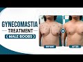 Best Gynecomastia Treatment (Male Boobs) in Jaipur | Expert Solution 🔥