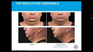 WEBINAR: The Skinny on CoolSculpting® Fact and Fiction