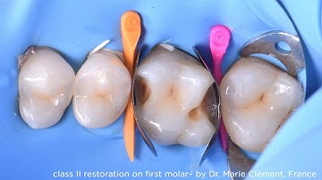 Class II restoration on first molar using myQuickmat Forte kit, case by Dr Marie Clément France