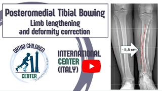 Posteromedial Tibial Bowing Limb Lengthening And Deformity Correction Orthochildren Center, Italy