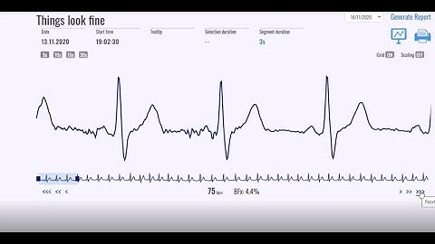 VitalPatch ECG Mobile Cardiac Monitoring