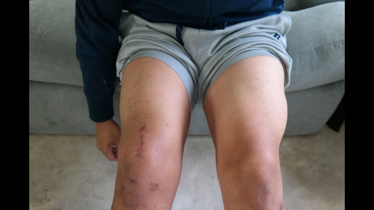 My Acl Surgery Recovery Quadriceps Tendon Graft Part 4 4 5 Weeks Youtube