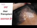 बाल प्रत्यारोपण के दुष्प्रभाव | Side Effects of Hair Transplant In Hindi | Satya Hair Clinic