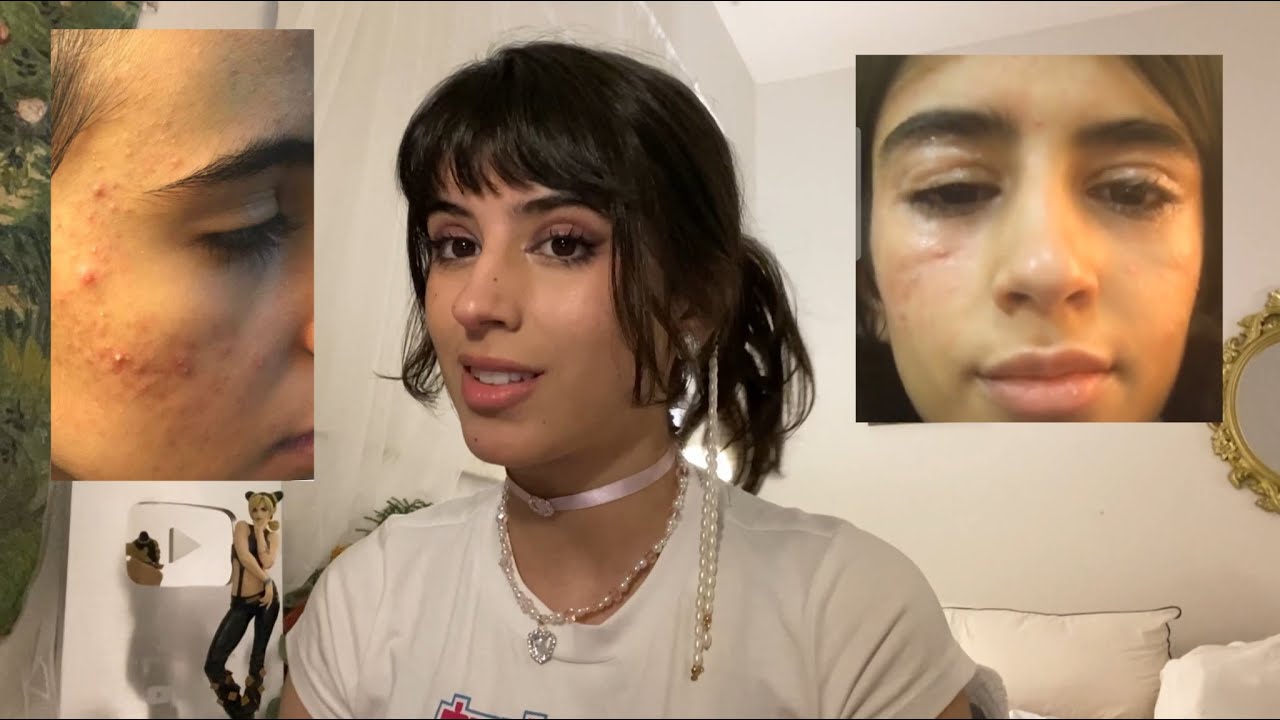 حبوب الشباب