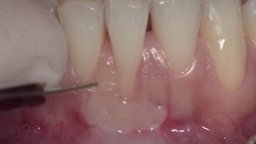 Double stage treatment of lower incisors recession