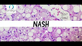 ESTEATOHEPATITIS NO ALCOHOLICA (NASH), características histológicas en biopsia hepática.