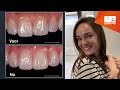 Uveneer® en Uveneer® Extra | Direct veneersjabloonsysteem