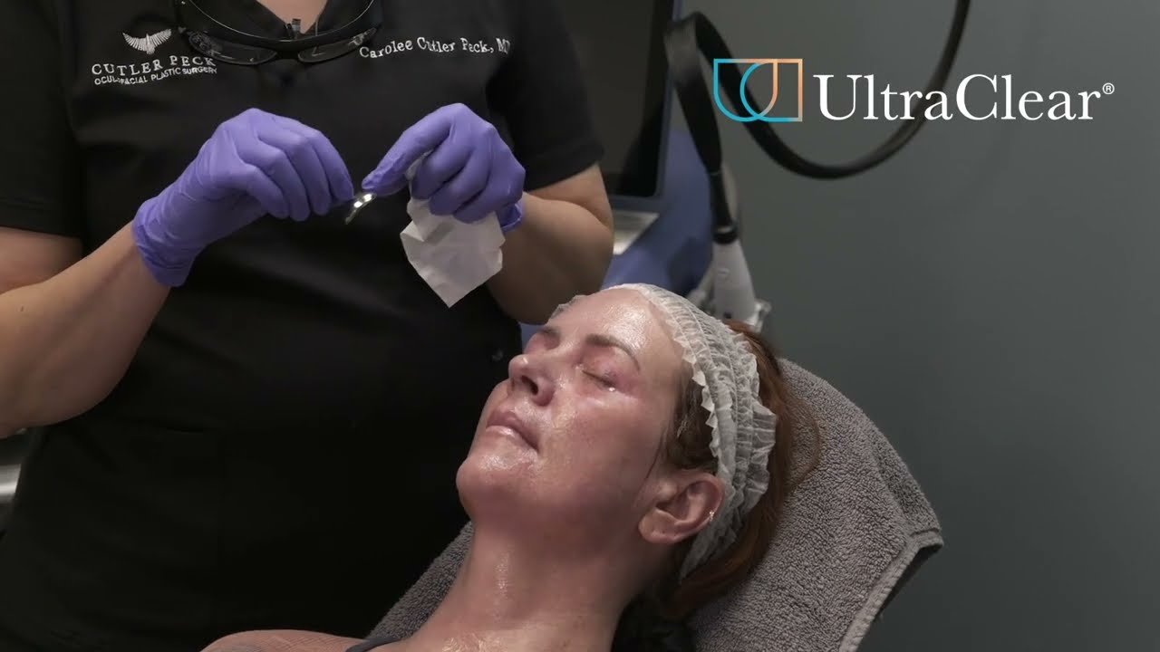 Laser-Coring™ + Customized UltraClear Treatment by Carolee Cutler Peck, MD, MPH