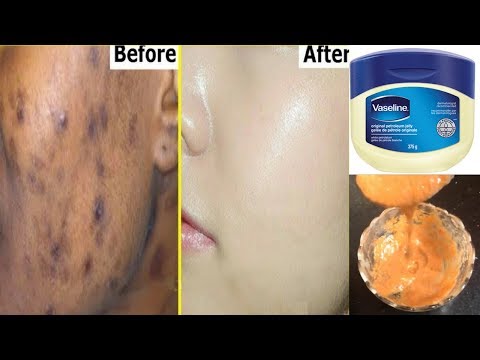 Remove Dark Spots In Just 3 Days With Vaseline | Get Rid Of Uneven Skin tone | Home Remedies