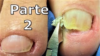 como sacar uña encarnada - como obter uma unha encravada - Impacted or Ingrown Toenail Pedicure