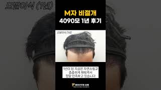 M자 비절개 모발이식 4090모 1년 뒤 모습