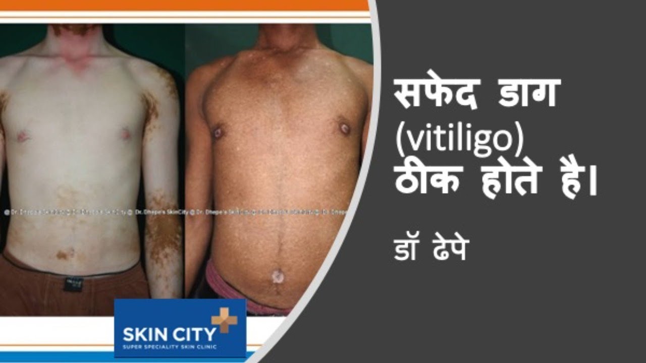 Vitiligo is treatable ! सफ़ेद दाग ठीक होते है ! Dr Dhepe  I skin city