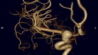 Beverly Hills Neurosurgeon - Dr. Parham Yashar - Coil Embolization - Brain Aneurysm, Pipeline Stent