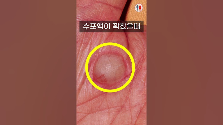[20만] 화상 입었을 때... 제발 제발 제발 하지마세요(덜렁대는 친구들한테 공유)