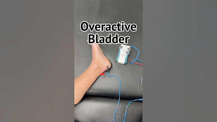 Percutaneous Tibial Nerve Stimulation (PTNS) for OAB