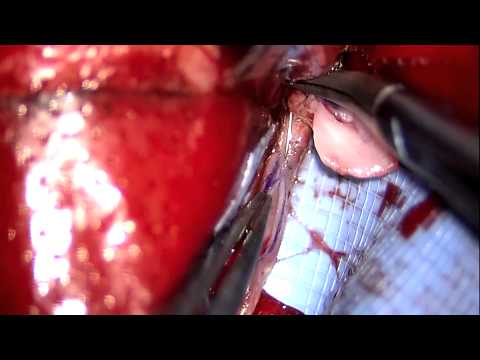 High Flow EC–IC Bypass For A Giant Left MCA Aneurysm