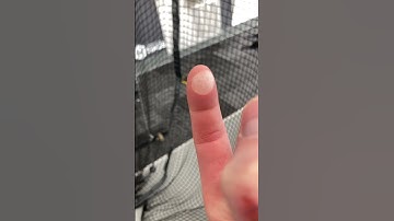 Blister from baseball pitching #baseball #sportsmedicine finger pain
