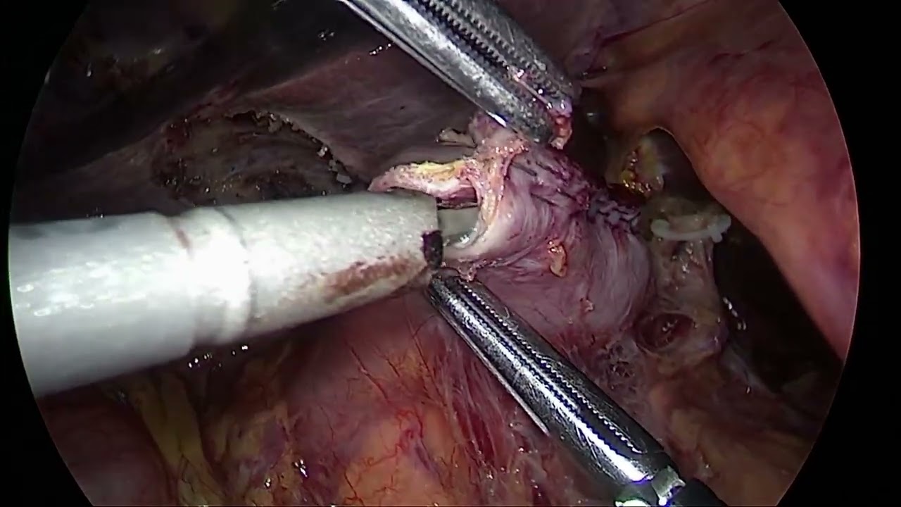 Laparoscopic overlap Billroth I reconstruction after distal gastrectomy for gastric cancer