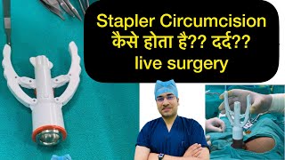 ZSR Circumcision live operation | How stapler circumcision is done | phimosis treatment |