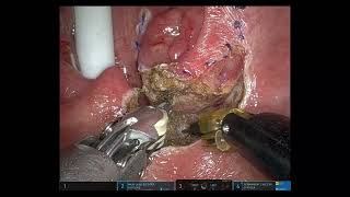 Transoral Robotic Surgery (TORS) Oropharyngectomy (Tonsillar cancer, Tonsillectomy) 구인두암 로봇수술 #1