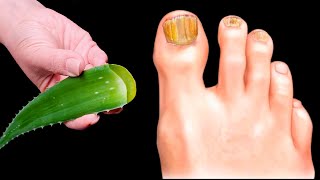 🔥Eliminates nail fungus IMMEDIATELY! The best remedy! Benefits of Aloe! 🌿😍