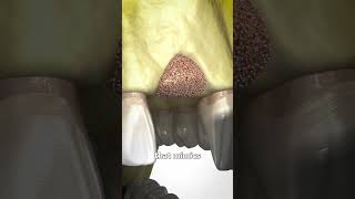 Thumbnail for Bone Grafting Explained 🤔
