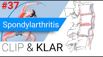 Welche Schmerzen bei Spondylarthritis?