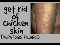 HOW TO GET RID OF CHICKEN SKIN (KERATOSIS PILARIS)| DR DRAY