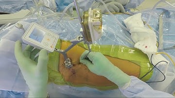 Live HipAlign Surgical Video with Dr. Durbhakula
