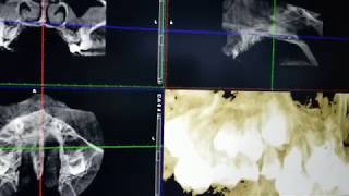All About Impacted Canines- CBCT . https://www.straightsmilesolutions.com/