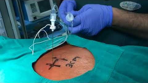 Landmark Guided Erector Spinae Block