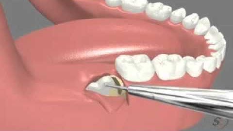 7  Impacted lower 3rd Molar Extraction Disto Angular    YouTube
