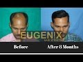 Hair transplant center in gurgaon  eugenix hair sciences