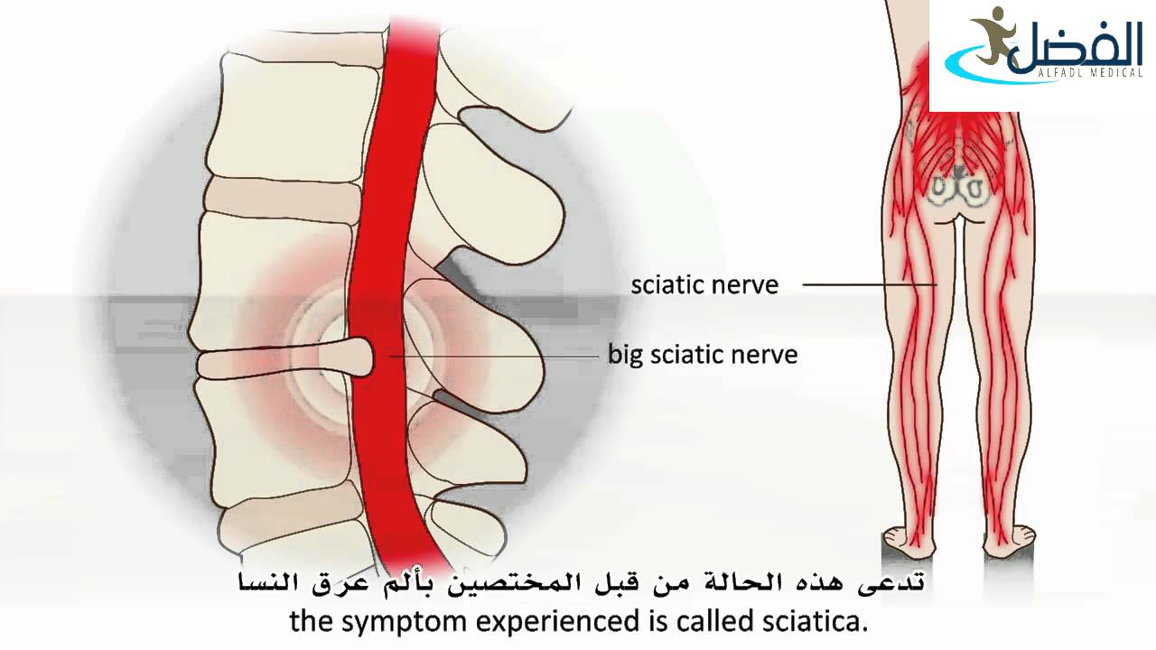 غضروفي في الظهر انزلاق الانزلاق الغضروفي