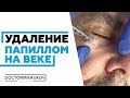 Удаление папиллом на веке Ростов-на-Дону #удалениепапиллом #удалениеродинок